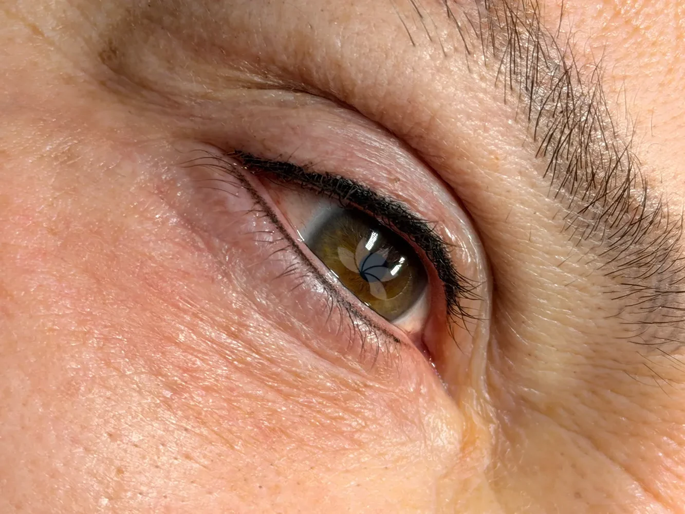 Nach der Wimpernkranzverdichtung (oben und unten)