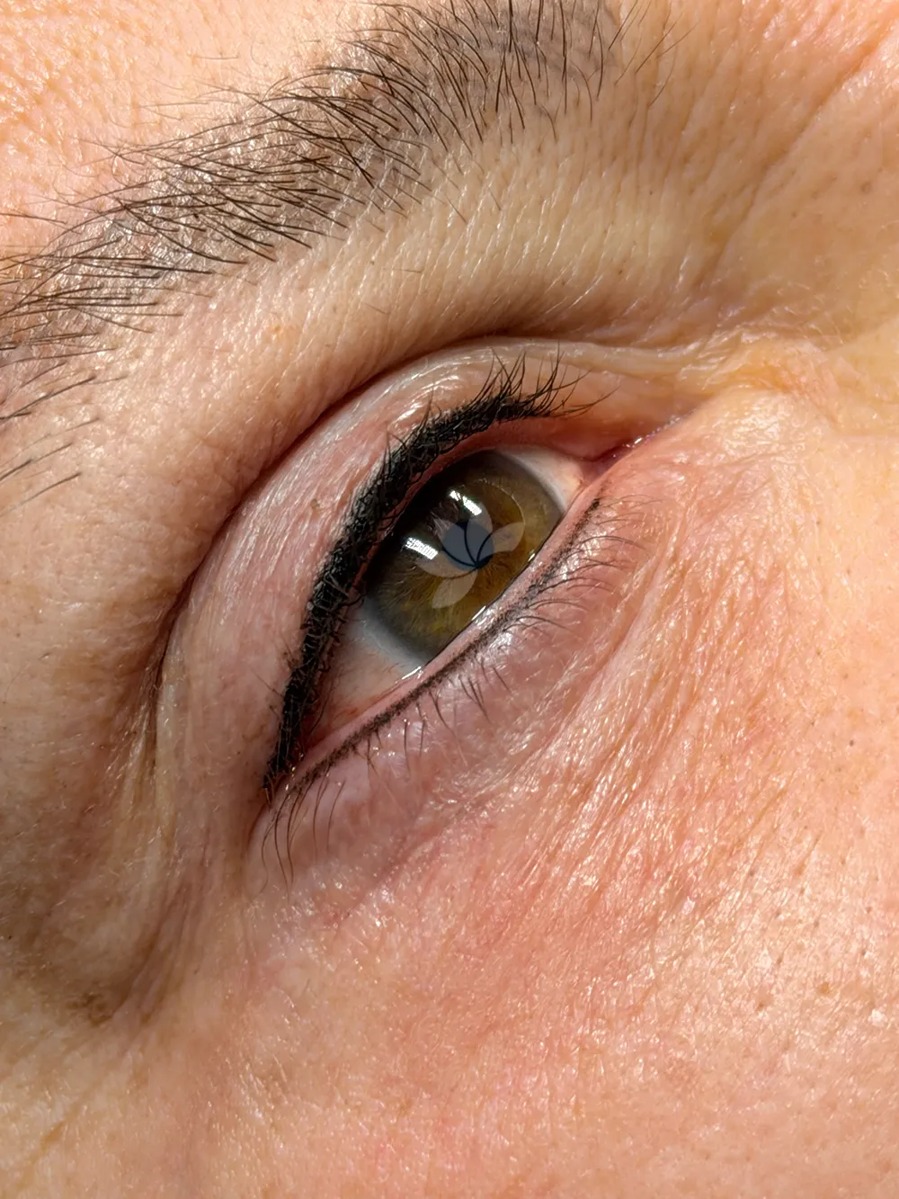 Nach der Wimpernkranzverdichtung (oben und unten)