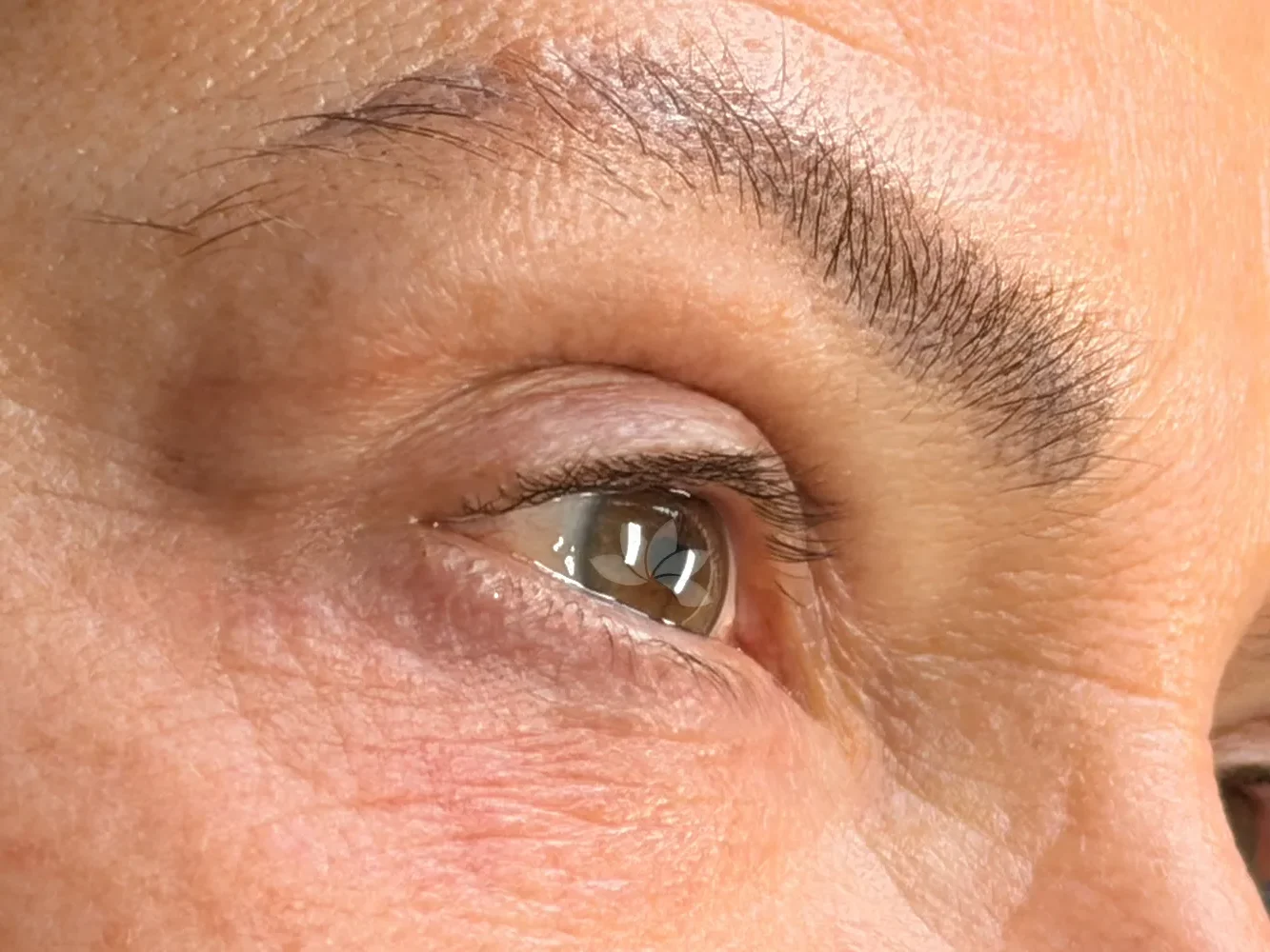 Vor der Wimpernkranzverdichtung (oben und unten)