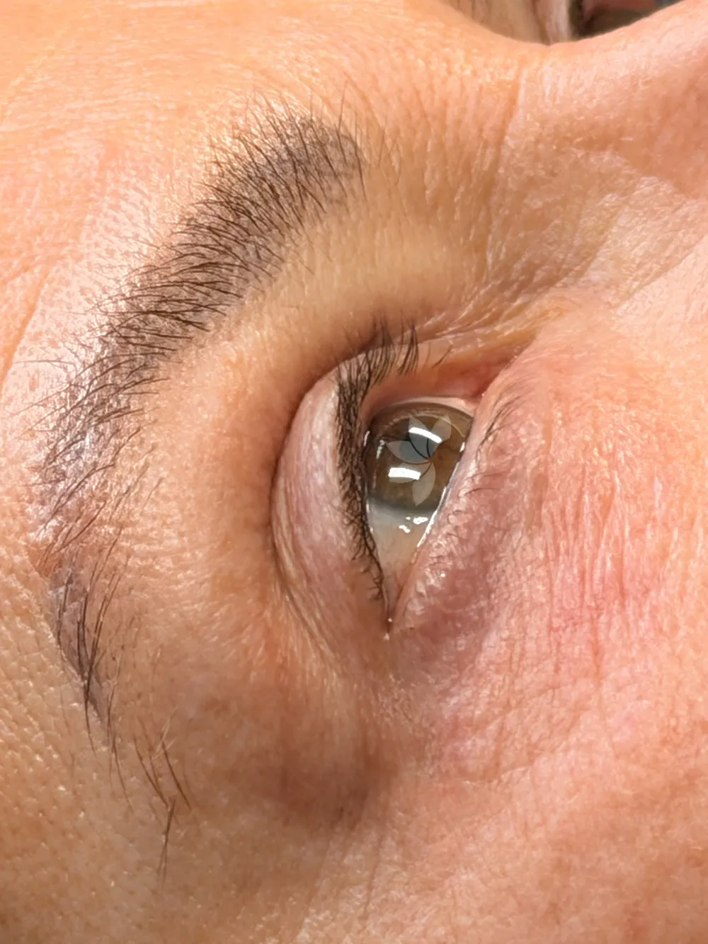 Vor der Wimpernkranzverdichtung (oben und unten)